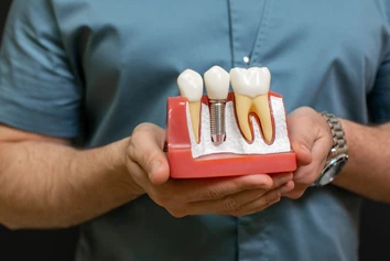 dental-implants-small
