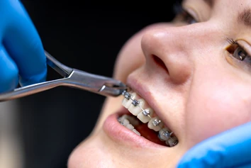 Orthodontic braces and smile alignment treatment for teeth correction
