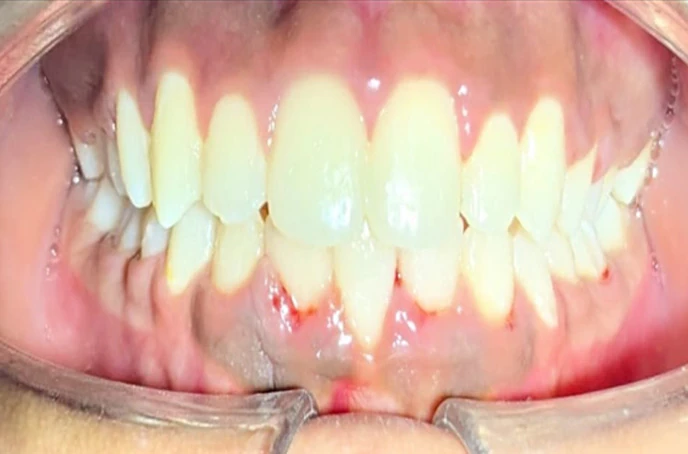 After smile makeover with brighter aligned teeth at Maxora Clinic Mumbai