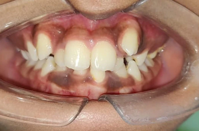 Before dental smile transformation showing discolored and uneven front teeth