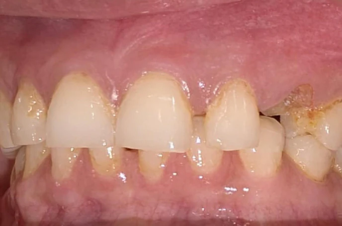 Before orthodontic treatment showing misaligned teeth with braces placement