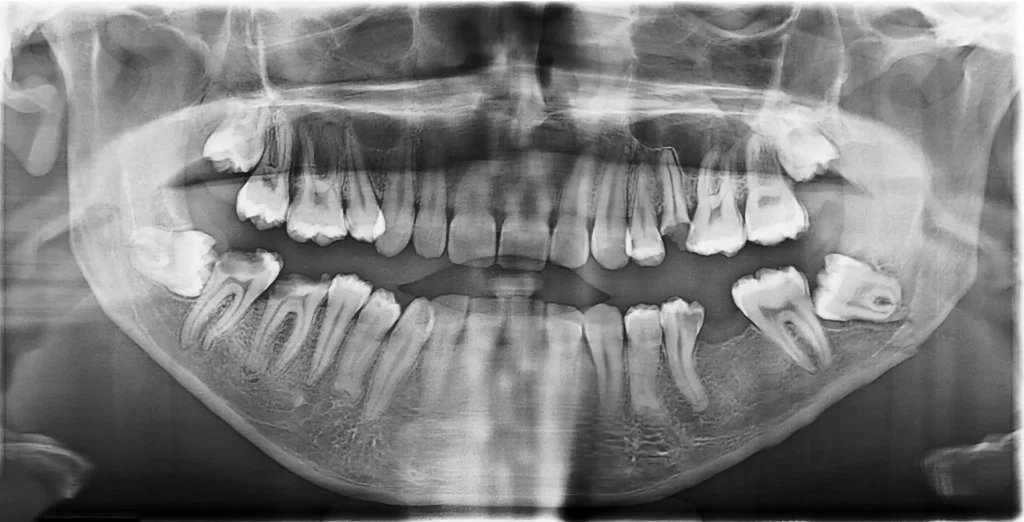 dental X-ray showing multiple impacted wisdom teeth (third molars) in the upper and lower jaw requiring surgical evaluation and extraction.