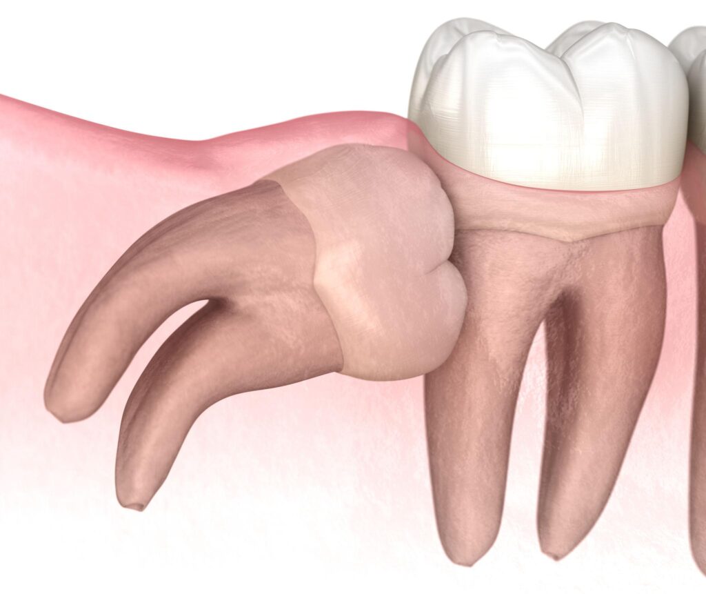 horizontally impacted lower wisdom tooth (third molar) pressing against the adjacent second molar beneath the gum.