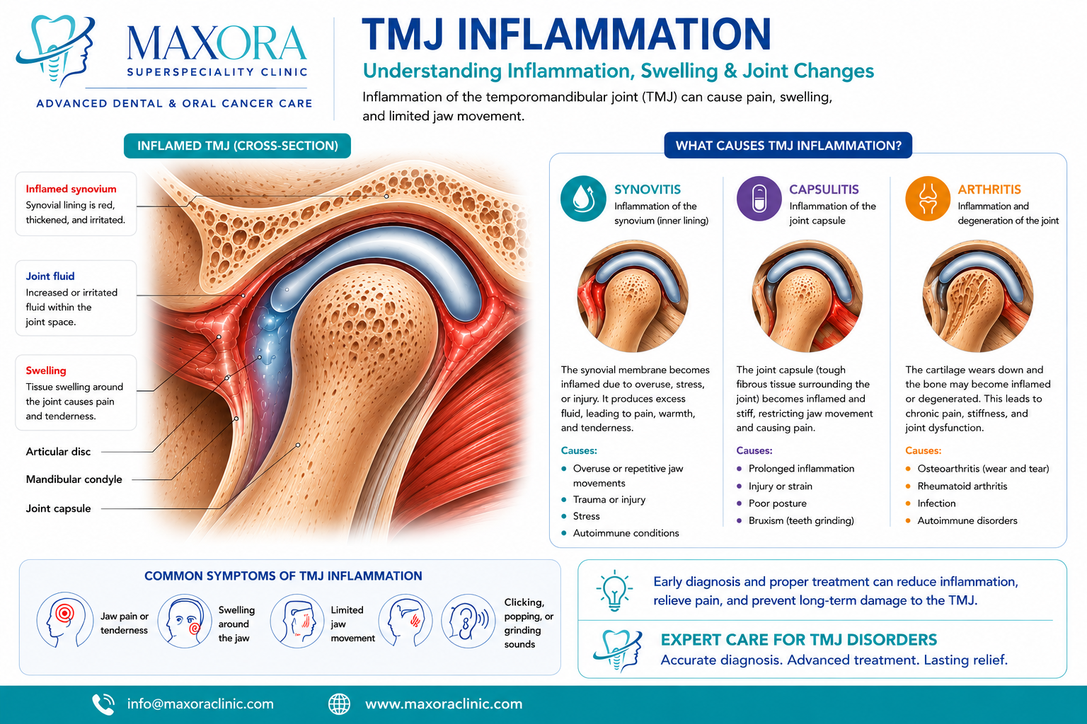 Detailed medical infographic illustrating temporomandibular joint (TMJ) inflammation with a cross-sectional anatomical diagram showing inflamed synovium, excess joint fluid, swelling, articular disc, mandibular condyle, and joint capsule. The infographic explains synovitis, capsulitis, and arthritis as causes of TMJ inflammation, along with common symptoms including jaw pain, tenderness, facial swelling, limited jaw movement, and clicking or popping sounds.